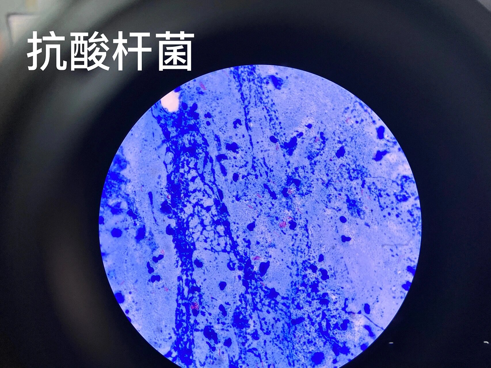 抗酸杆菌(抗酸染色