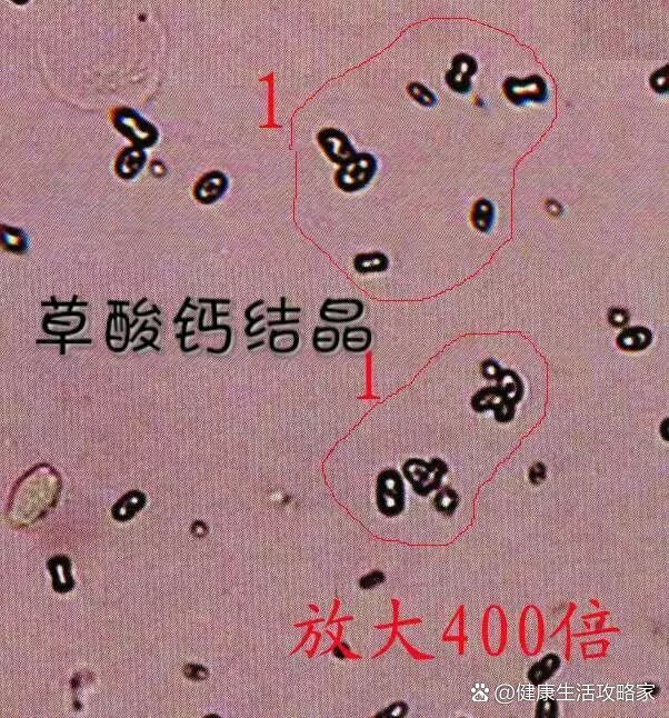 草酸钙结晶图图片