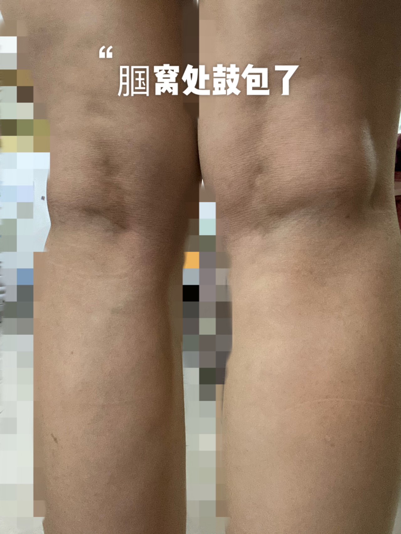 求治疗办法或者建议🙏🙏🙏不是腘窝囊肿,如果是脂