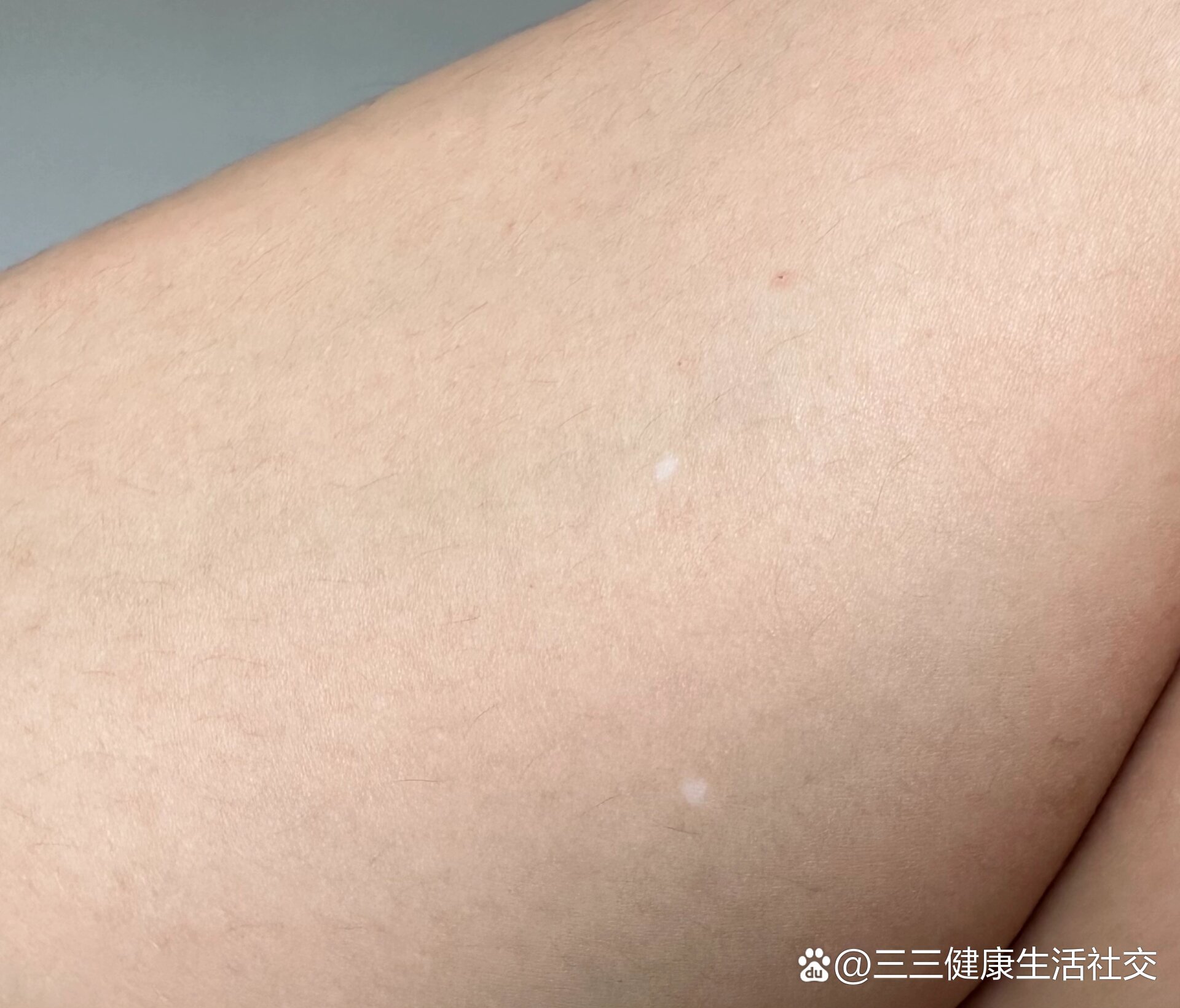 身上莫名长小白点