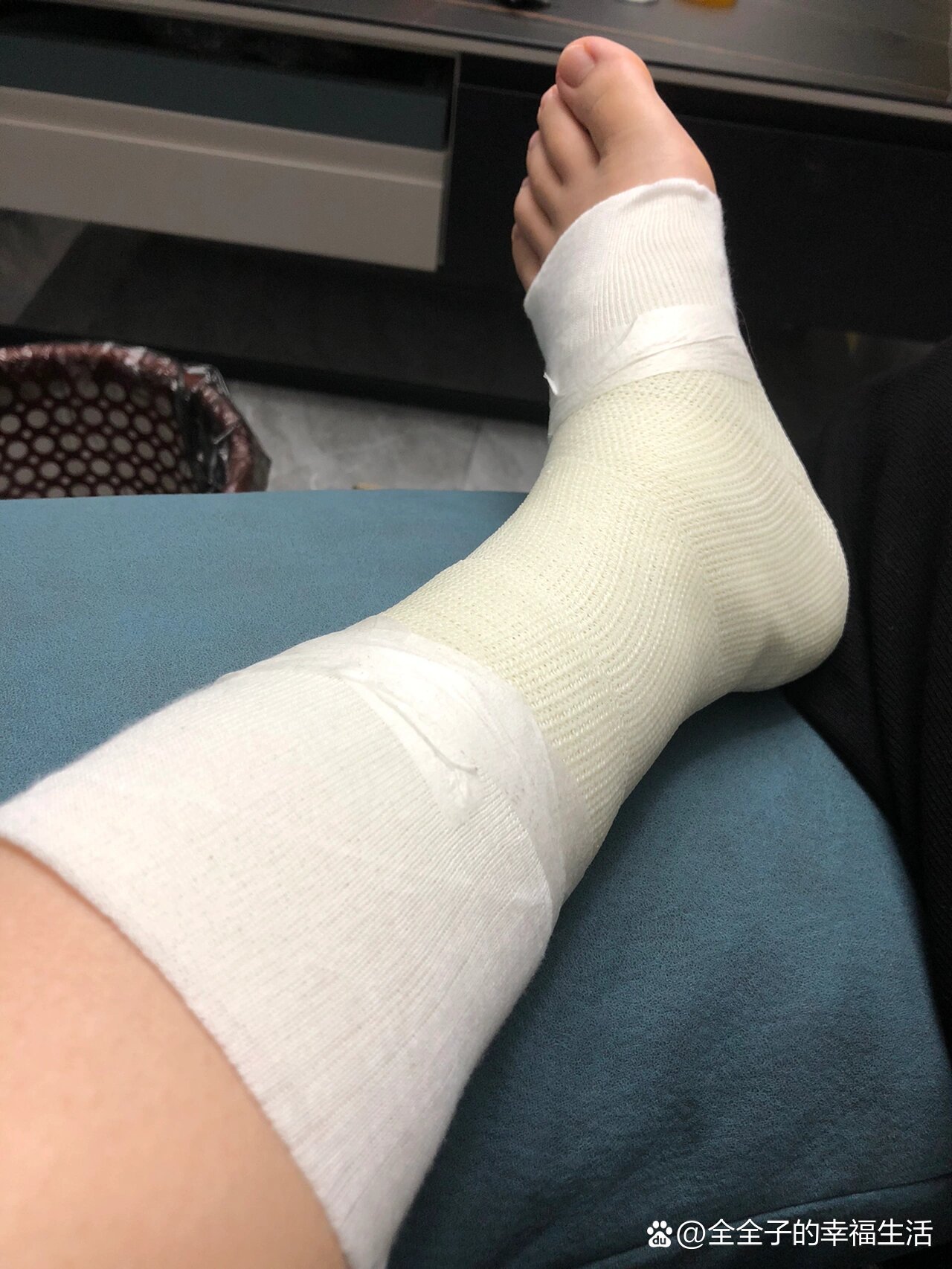 崴脚第16天,确诊韧带损伤,上石膏了