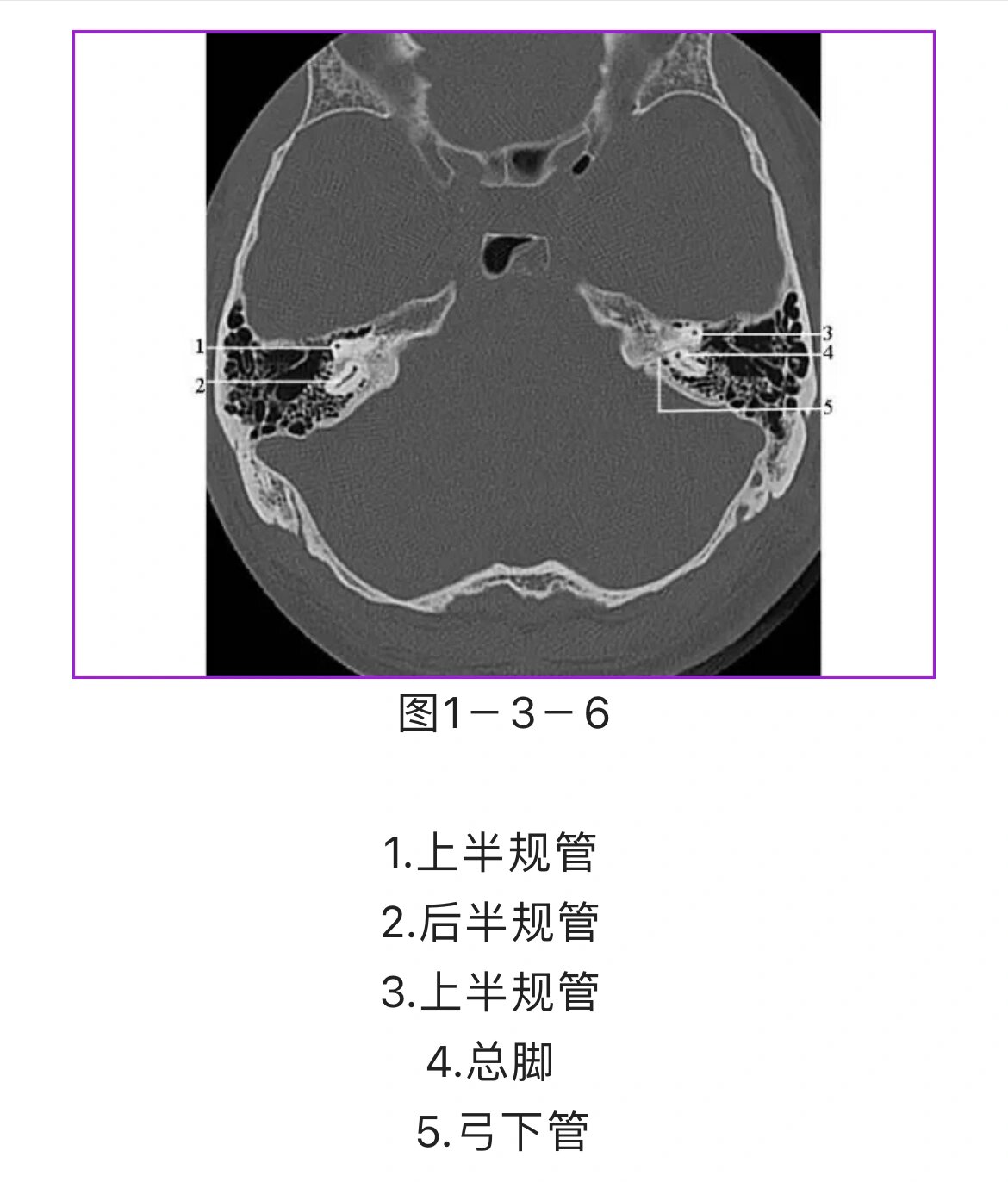影像学干货|颞骨ct解剖(轴位)