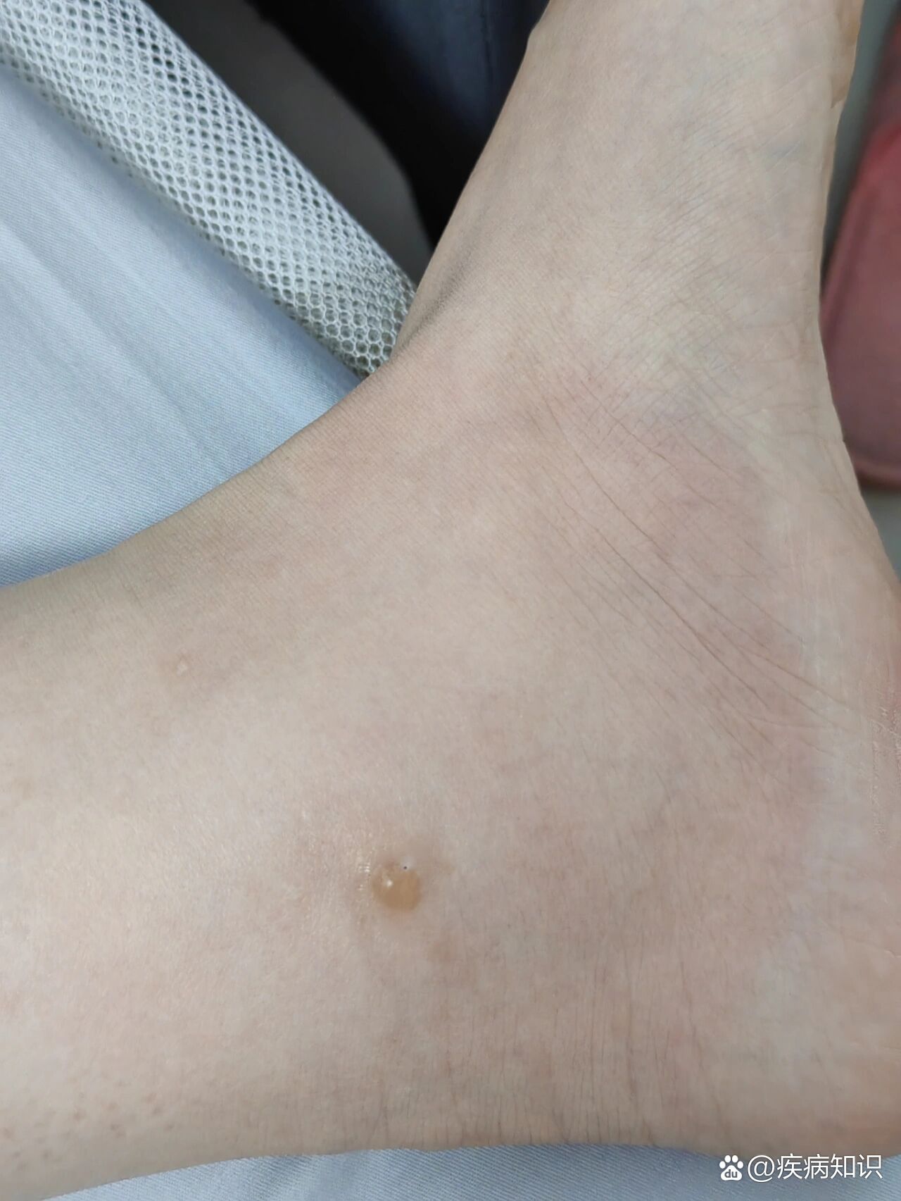 请问这是被什么虫子咬了,每次都要出个水泡