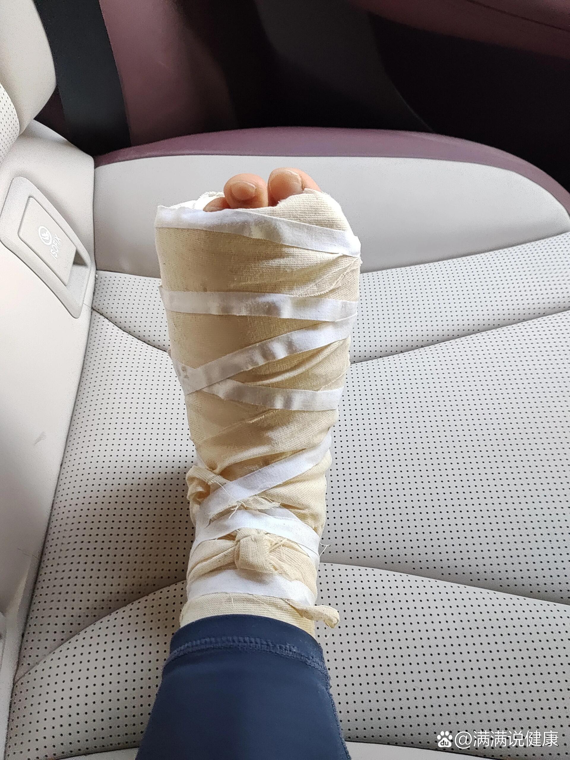 第五跖骨基底骨折第28天