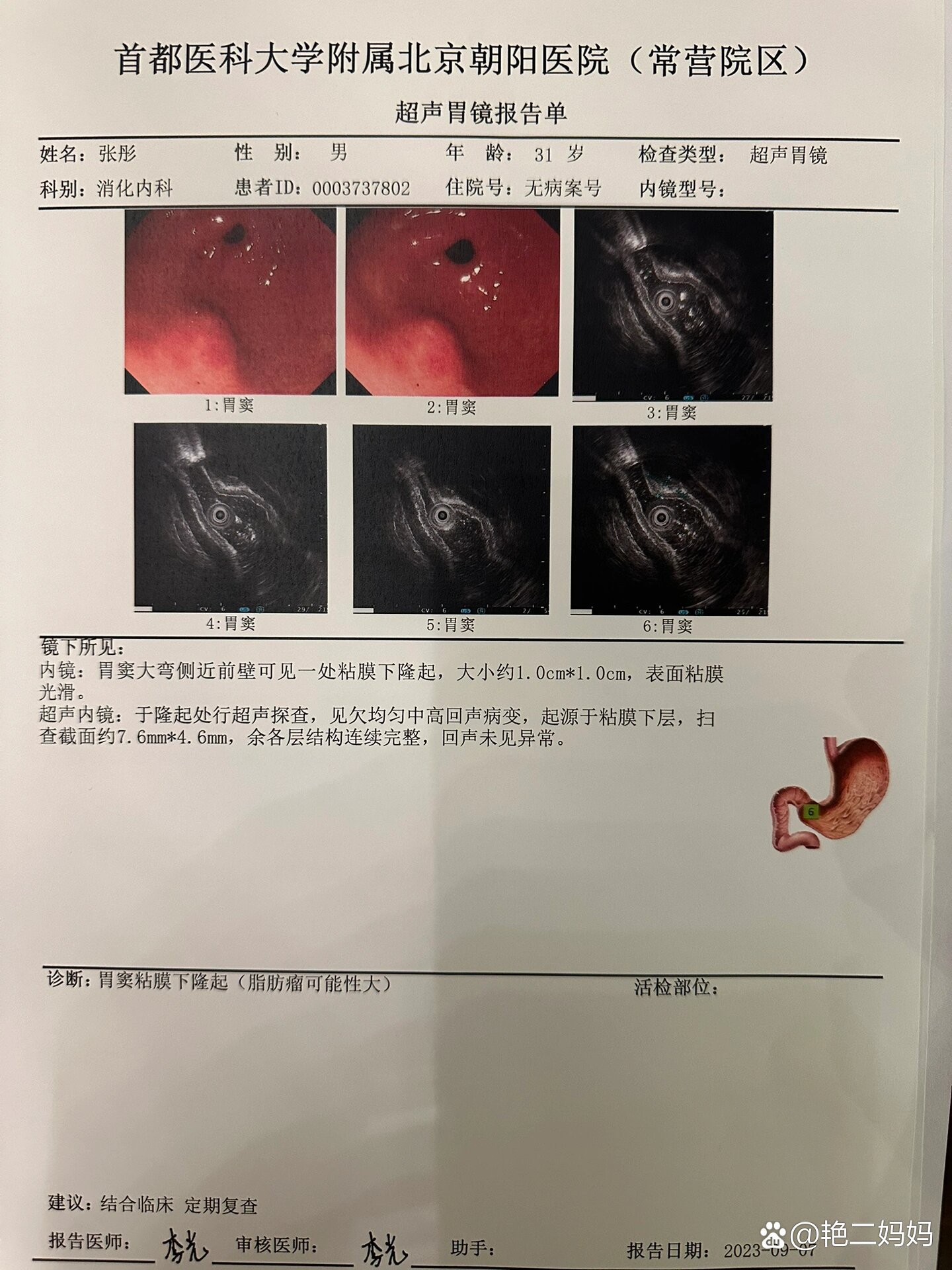 胃间质瘤胃镜图片图片