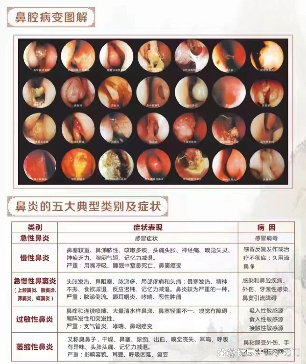  p>鼻科分类情况? br>鼻炎内镜图你看过吗? br>鼻炎各种分类你知道吗?