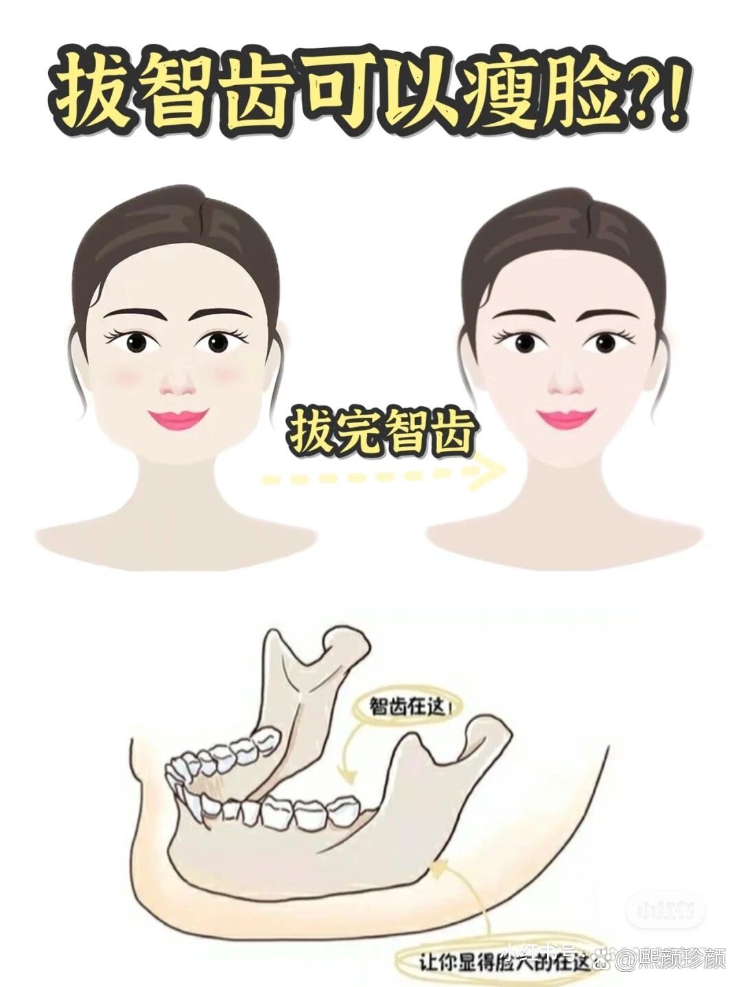 拔智齿改变脸型