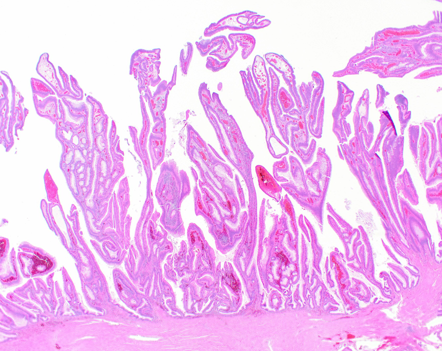 发生于阴道的绒毛状腺瘤可通过手术切除治疗