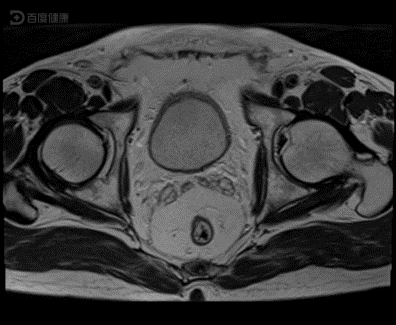 大爷不幸确诊为膀胱原位癌,电切术后好转