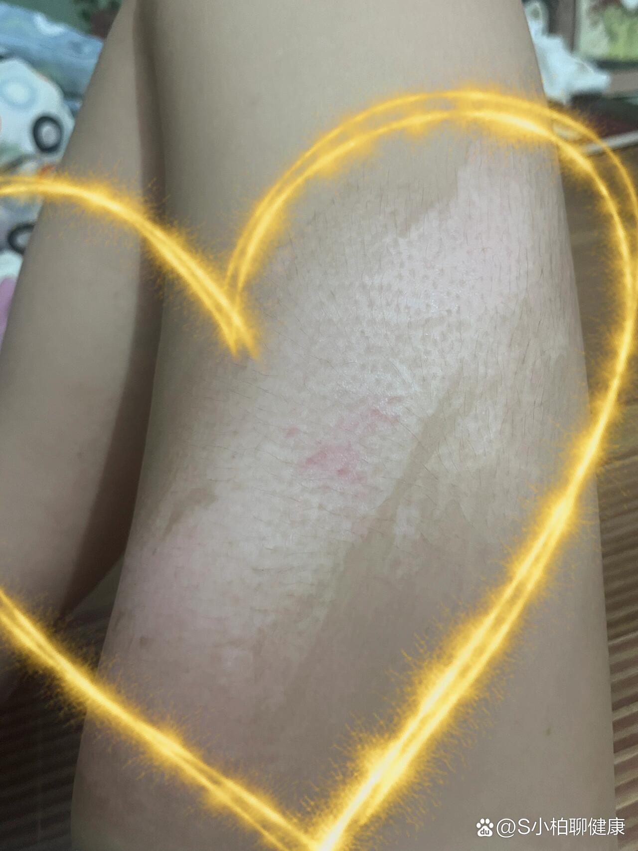 烫伤后色素脱失了怎么办啊