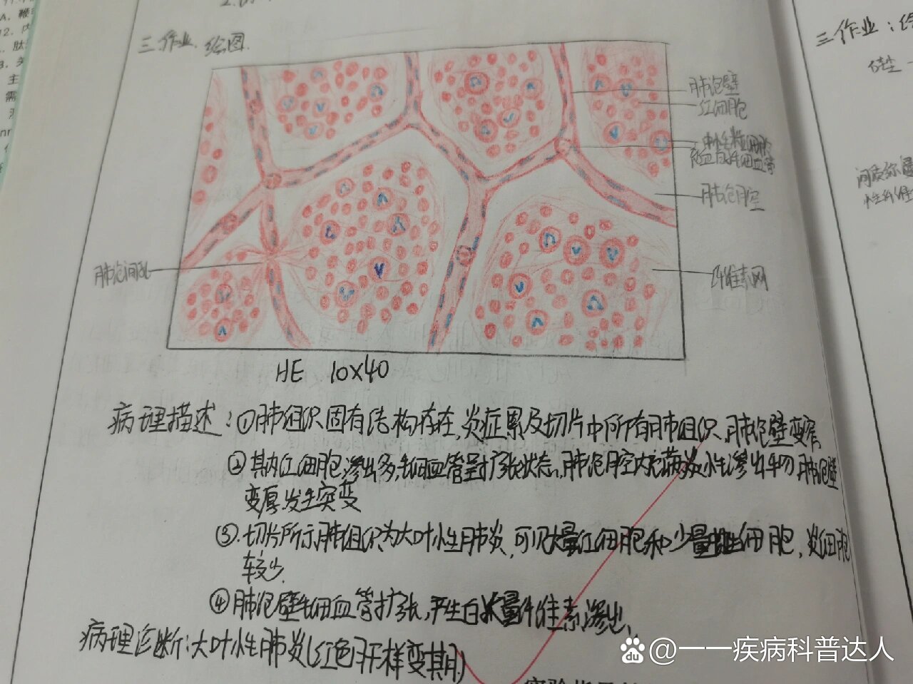 病理切片-大叶性肺炎