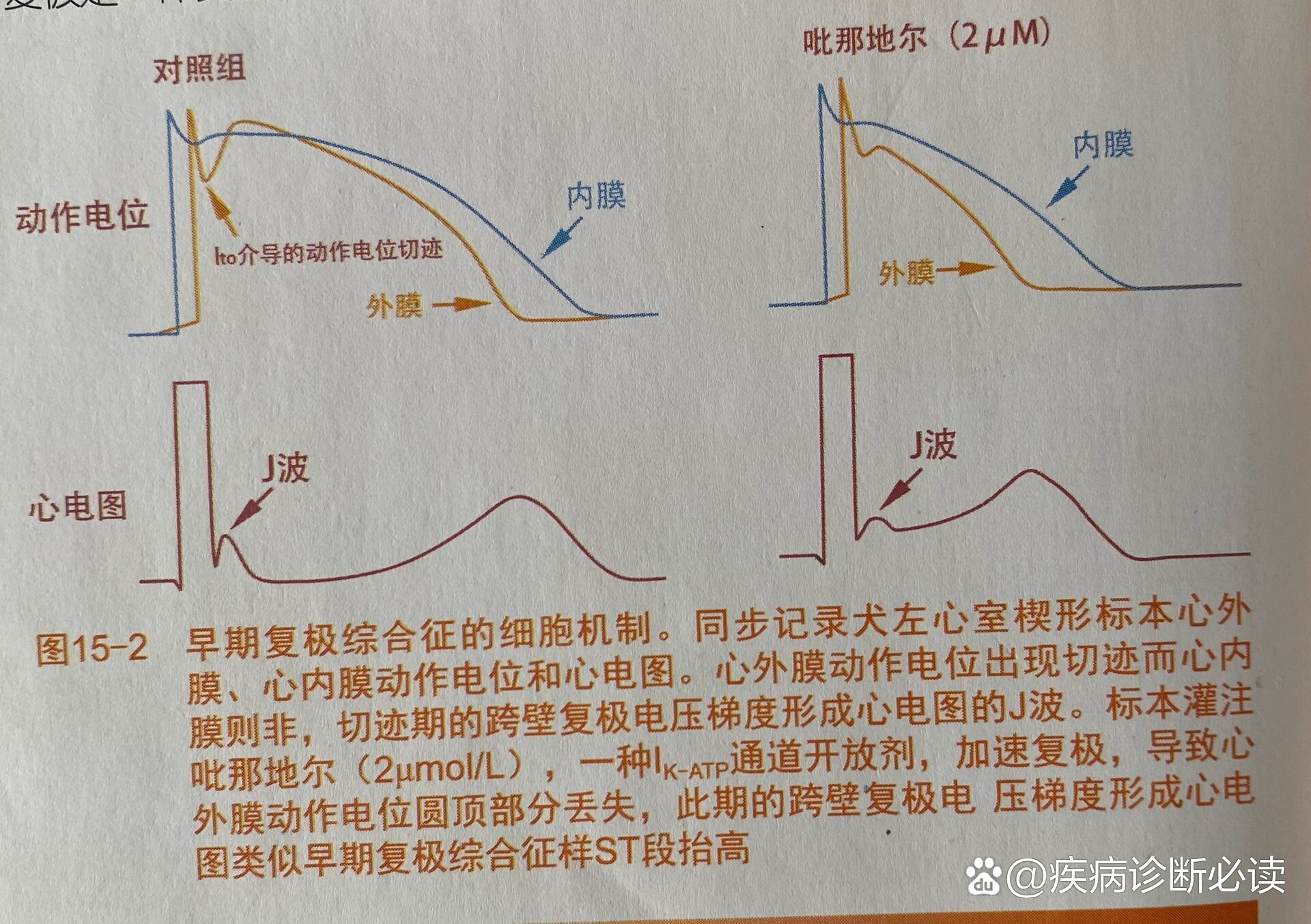 早期复极心电图图片