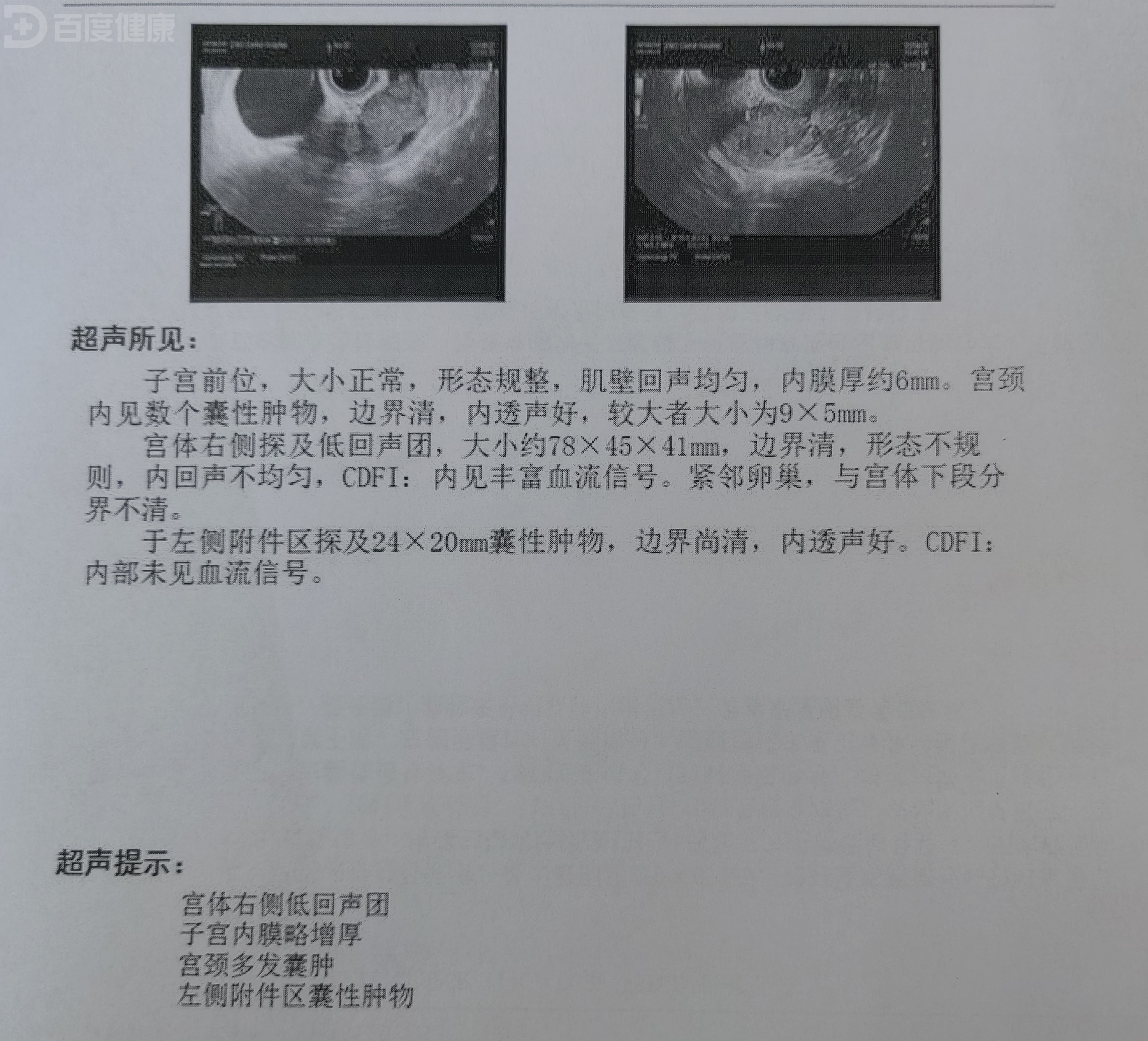 卵巢癌ii期患者的治疗方案