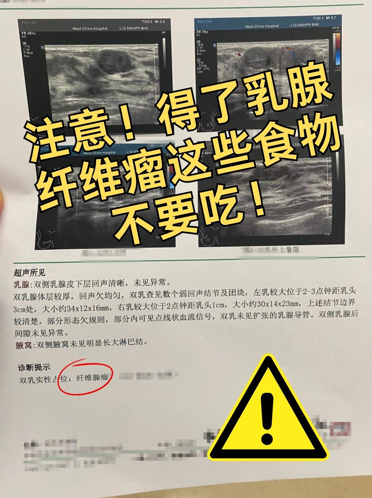 乳腺纤维瘤分叶状图片图片