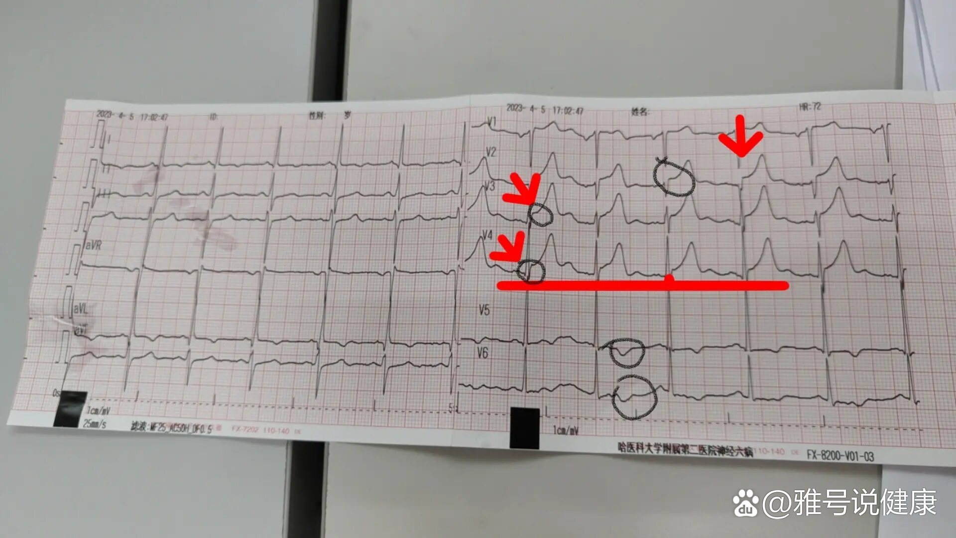 st弓背向下抬高图片