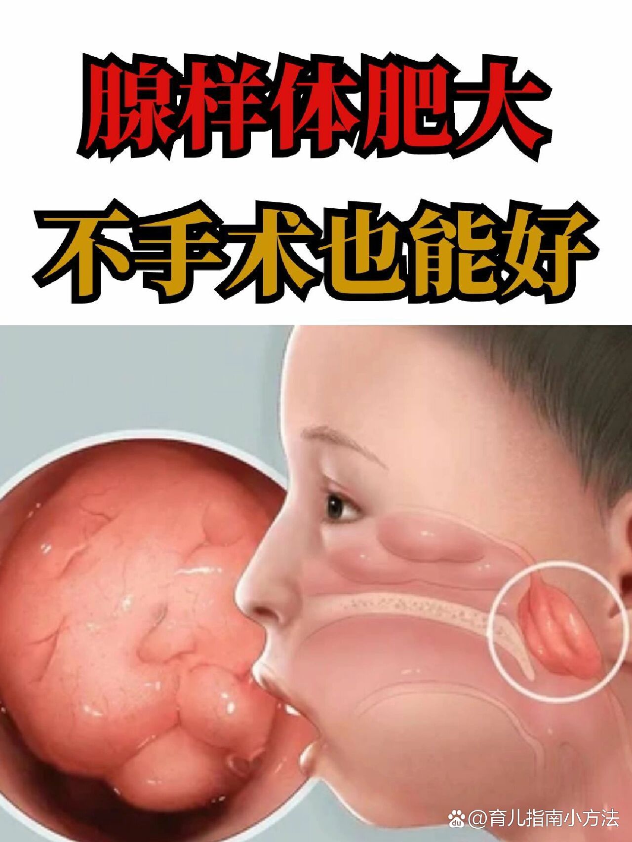一位宝妈说:孩子腺样体切除后,我很后悔!