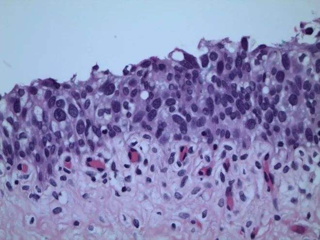 膀胱原位癌恶性程度高,日常需警惕