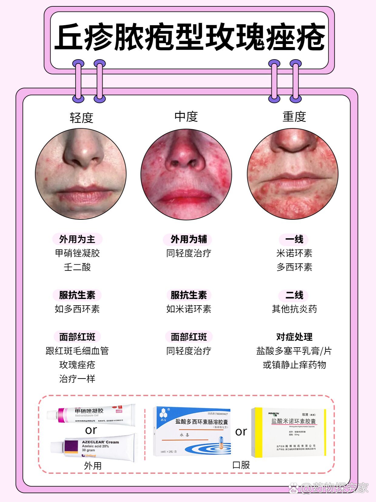 科普|丘疹脓疱型玫瑰痤疮的分级和治疗方法