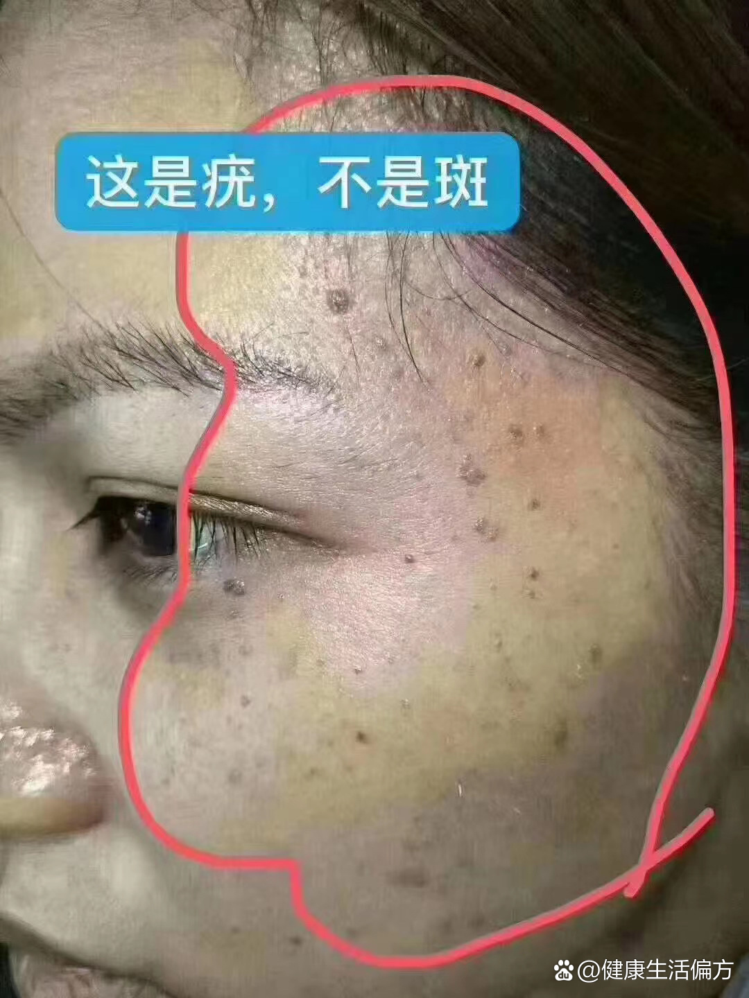 面部凸起图片