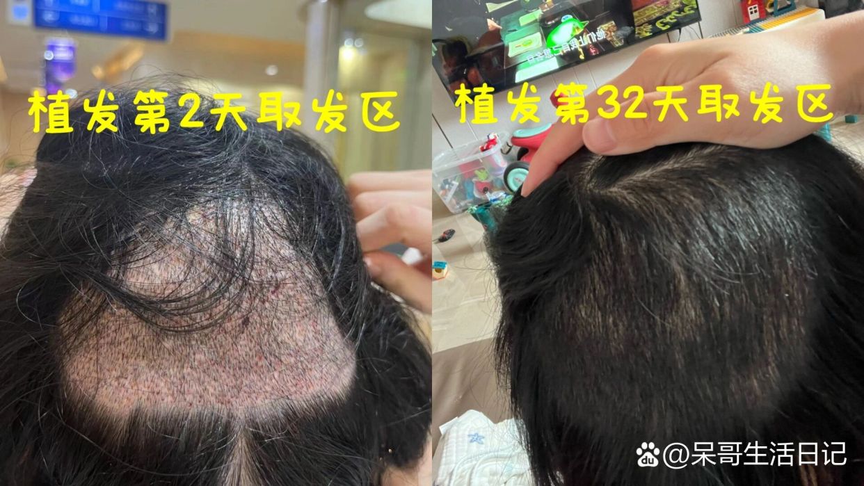 剃发植发取发区头发长长啦