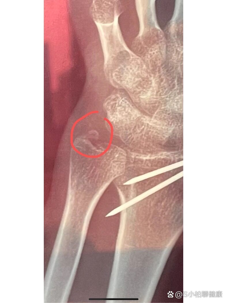 碎掉的小尺骨茎突|骨折第三十天