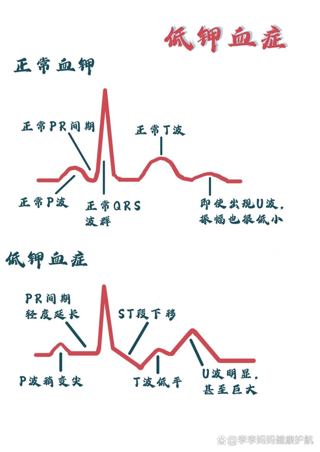 低钾血症的心电图特征图片