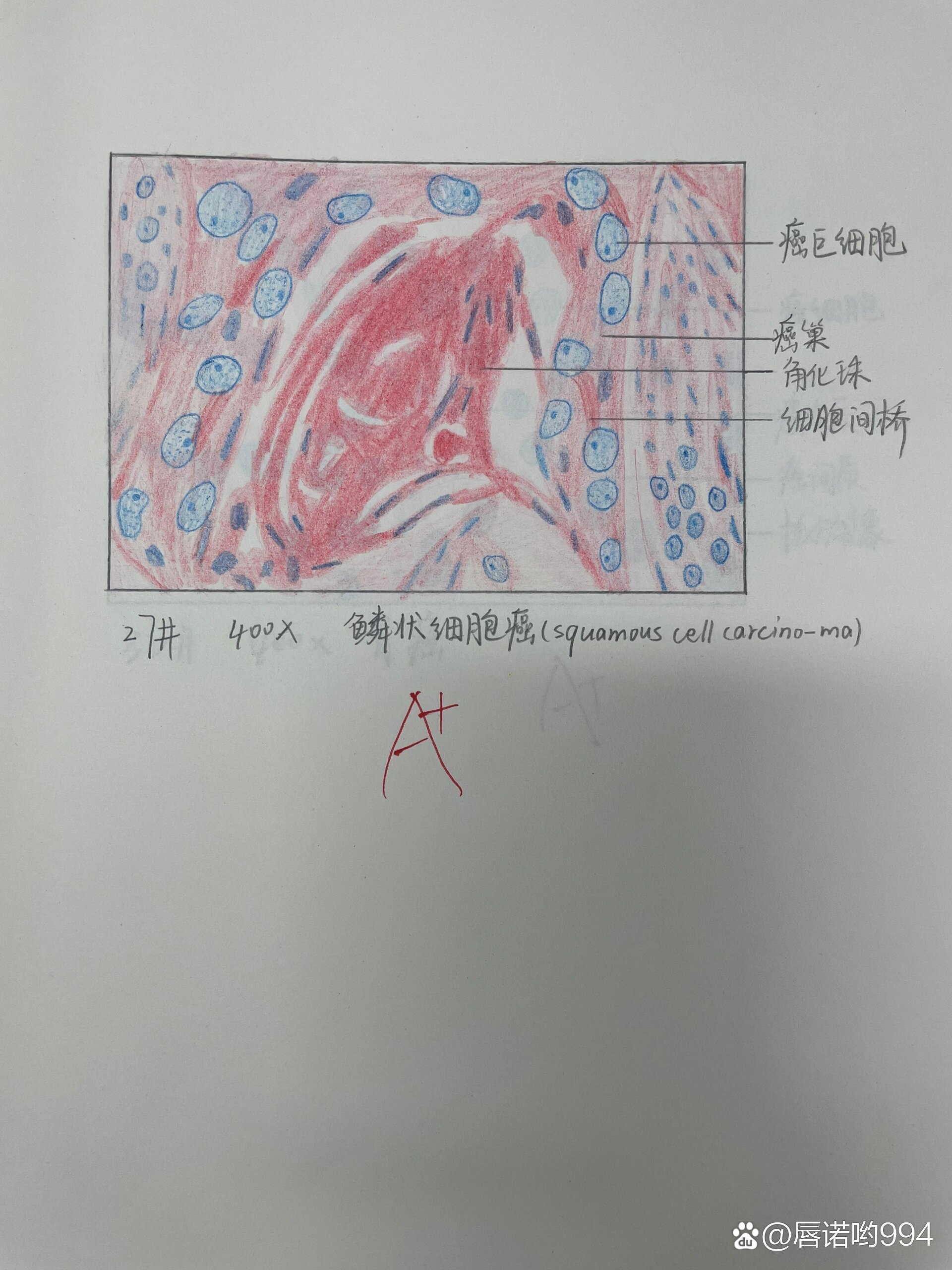 乙脑病理红蓝铅笔图图片