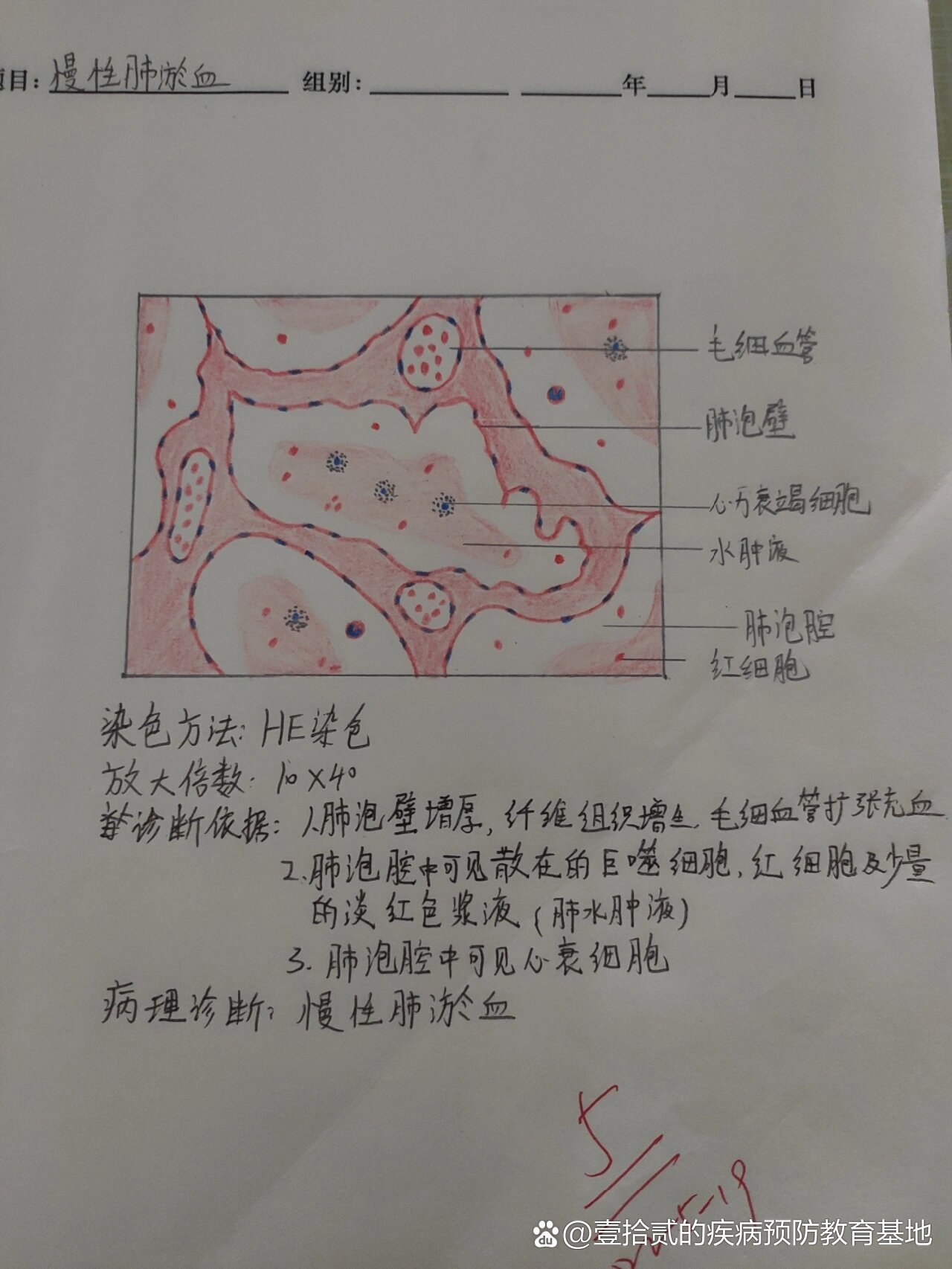 急性肺淤血40×手绘图图片