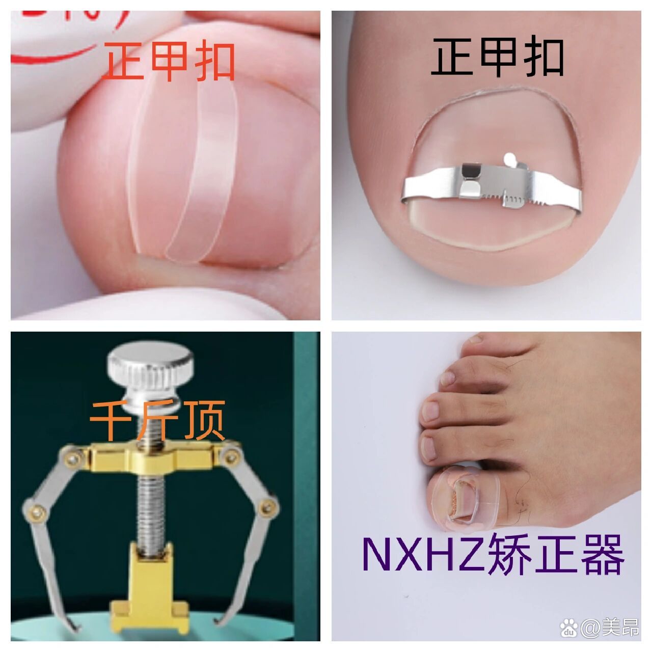 亲测4种嵌甲矫正器,其实治好嵌甲很简单