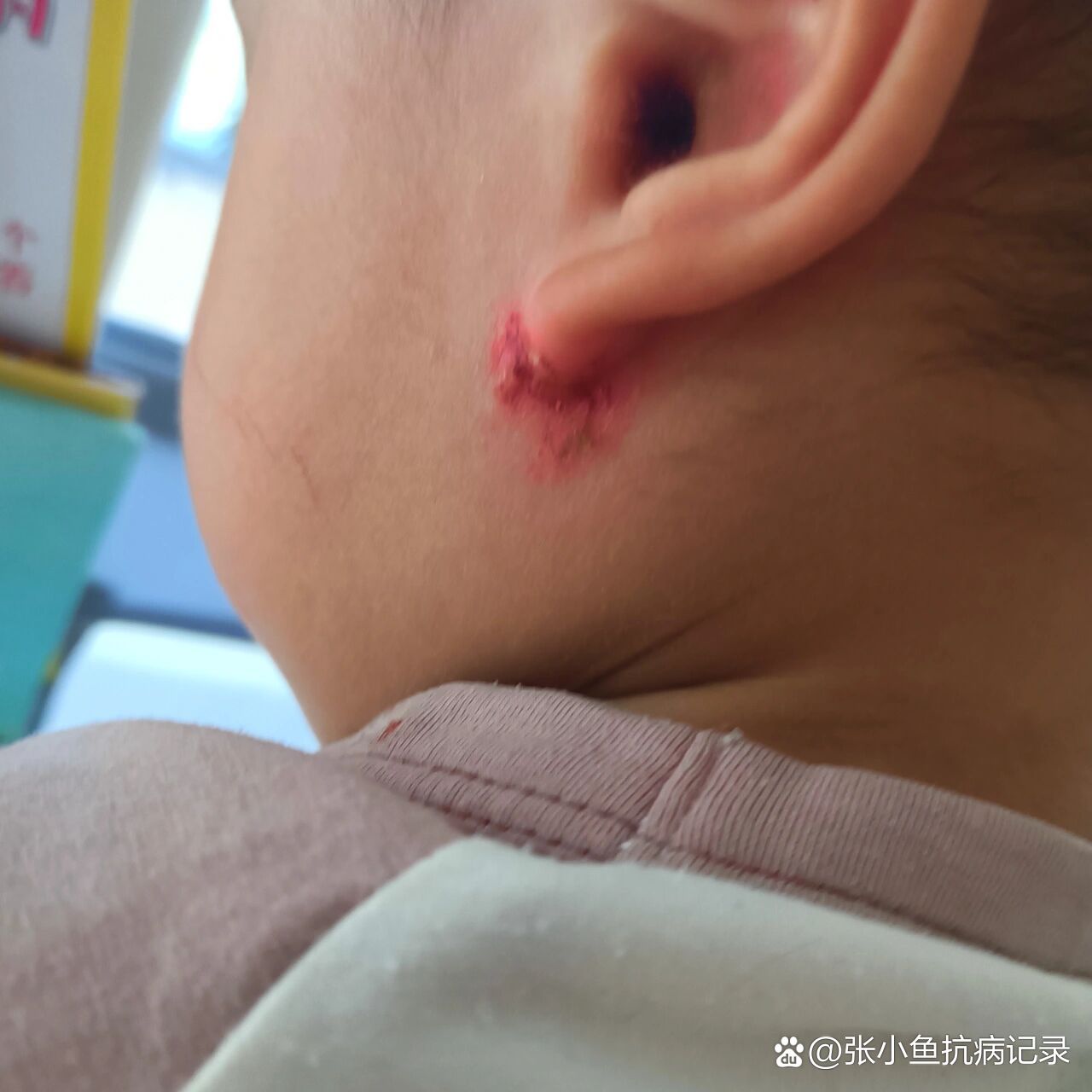 耳根反复的湿疹,妈妈严重的鼻炎