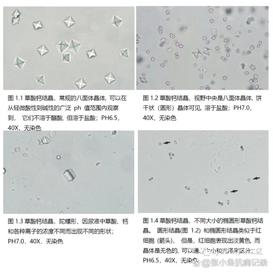 尿液中的结晶图片