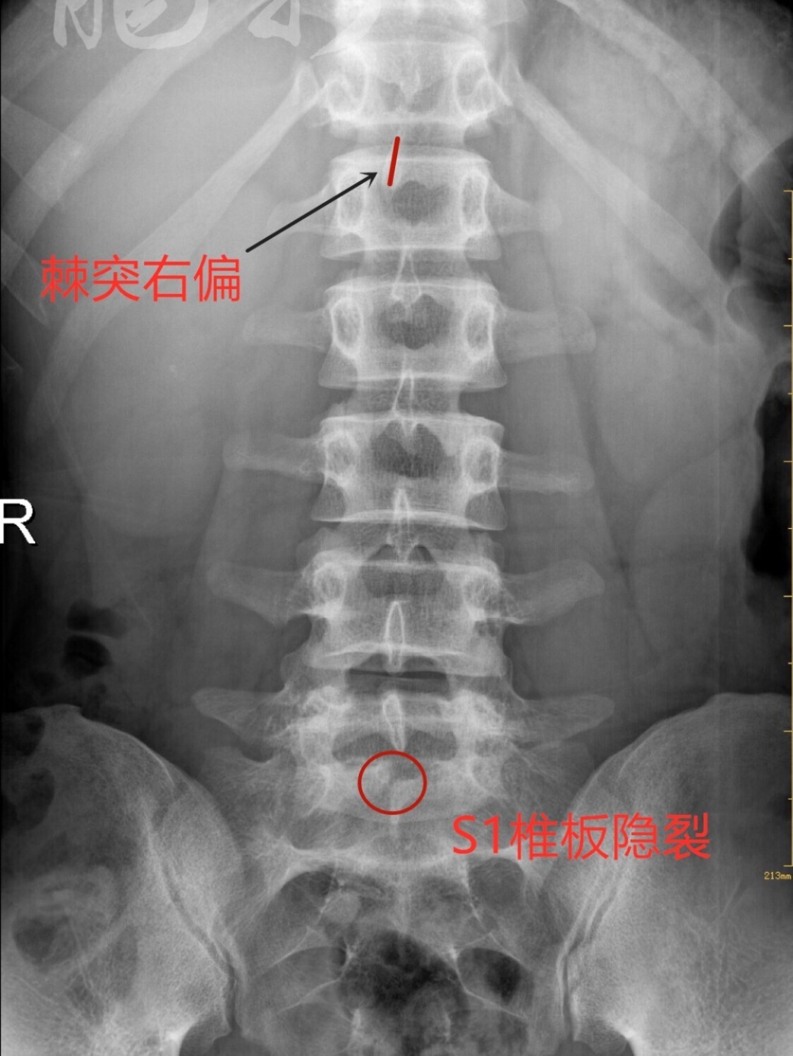 隐性脊柱裂x光片图片