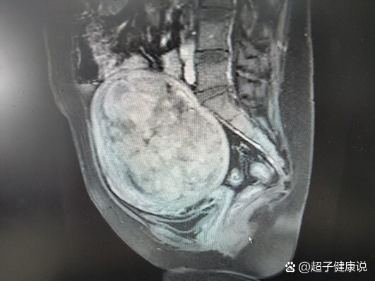 困扰我三年的多发性子宫肌瘤,海扶刀救了我