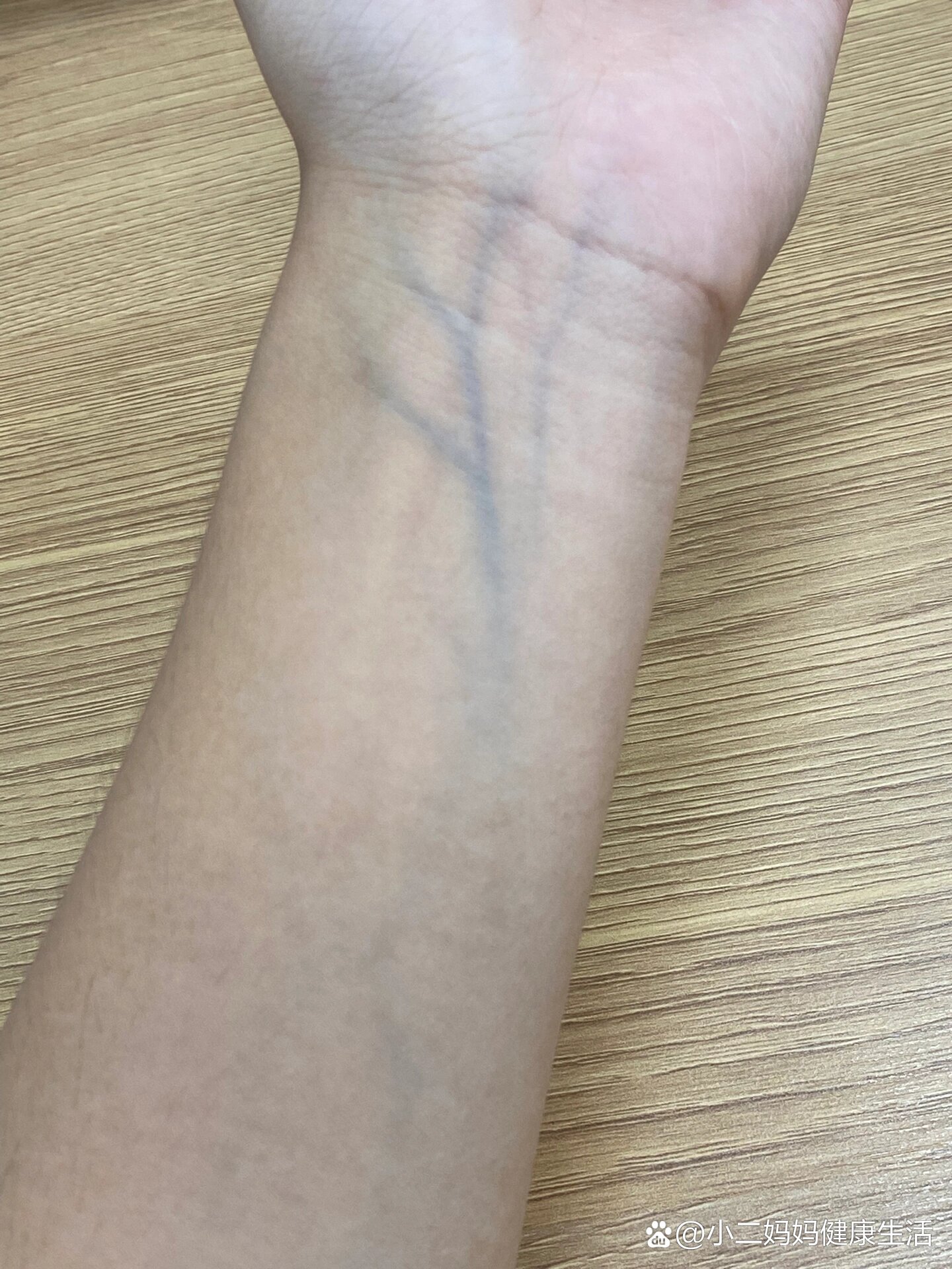 手腕上血管这么明显正常吗