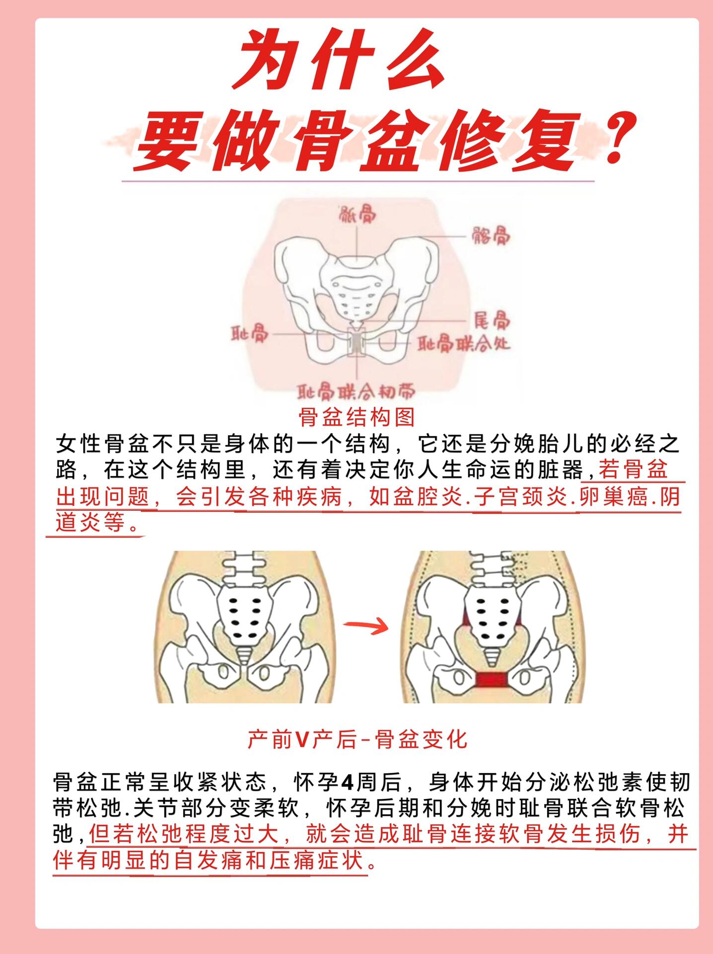 骨盆修复效果图真人图图片