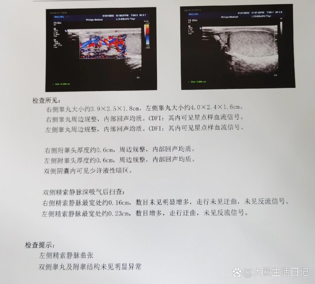 精索静脉曲张