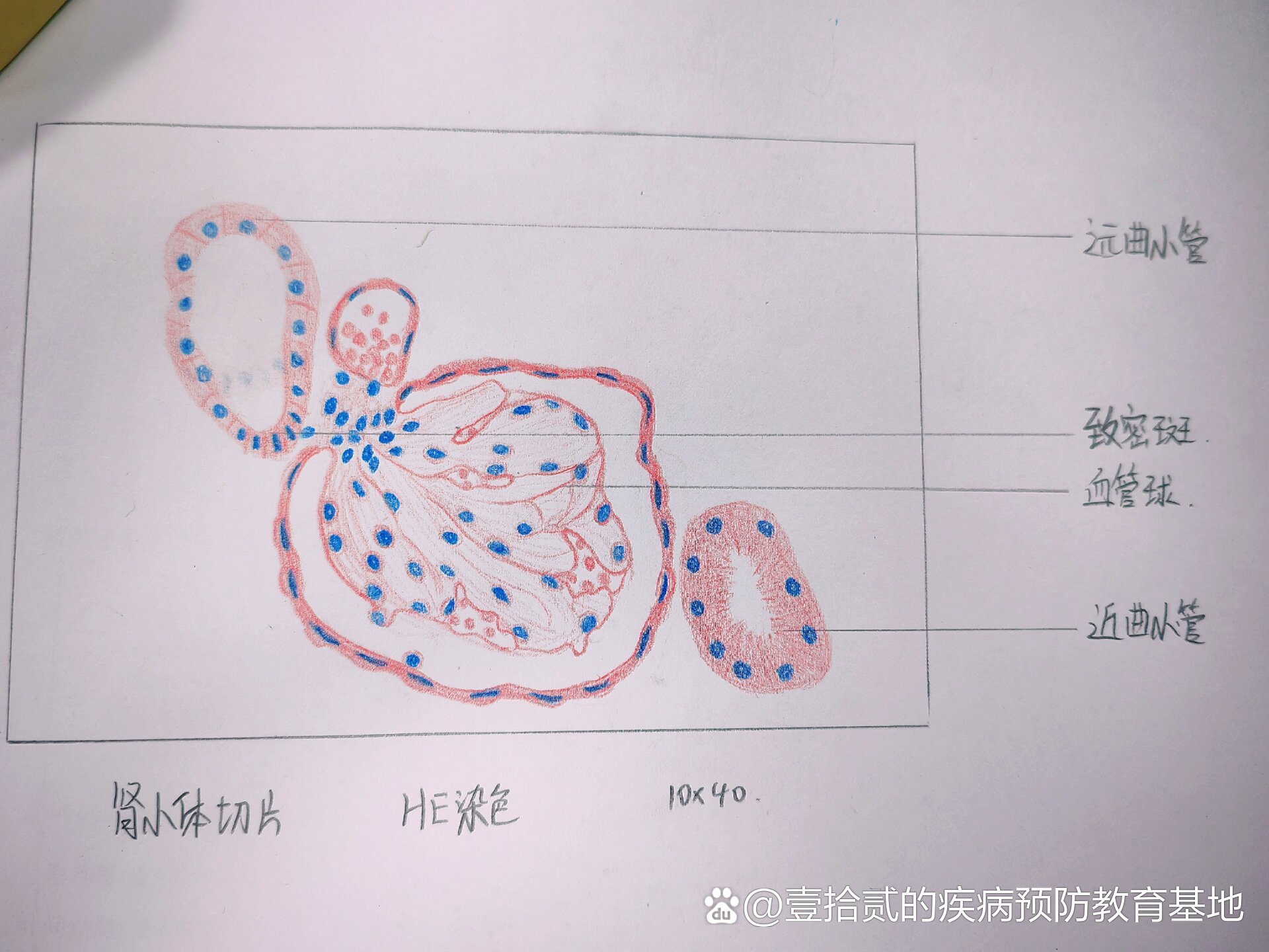 慢性肾小球肾炎手绘图图片