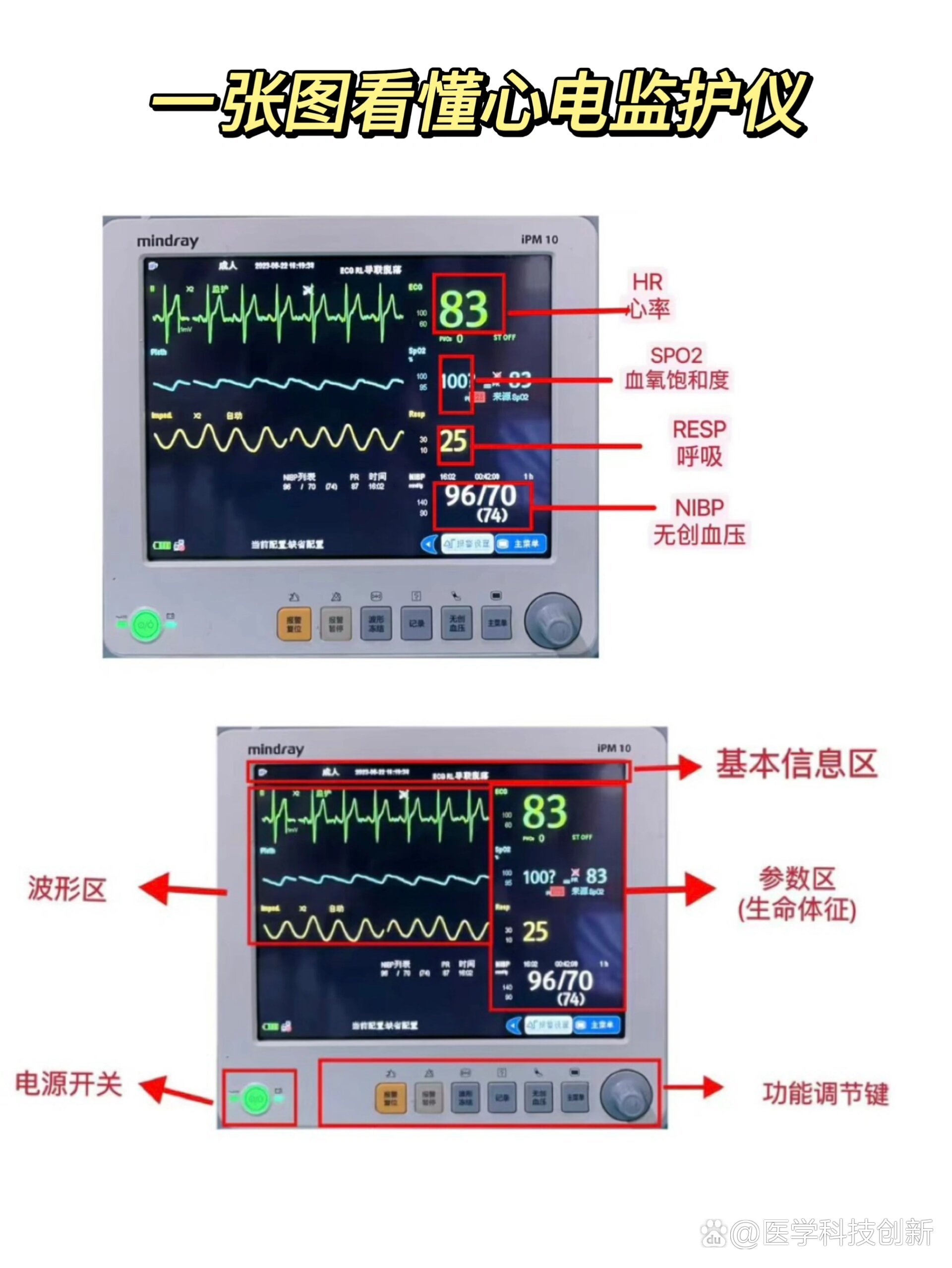 一张图看懂心电监护仪