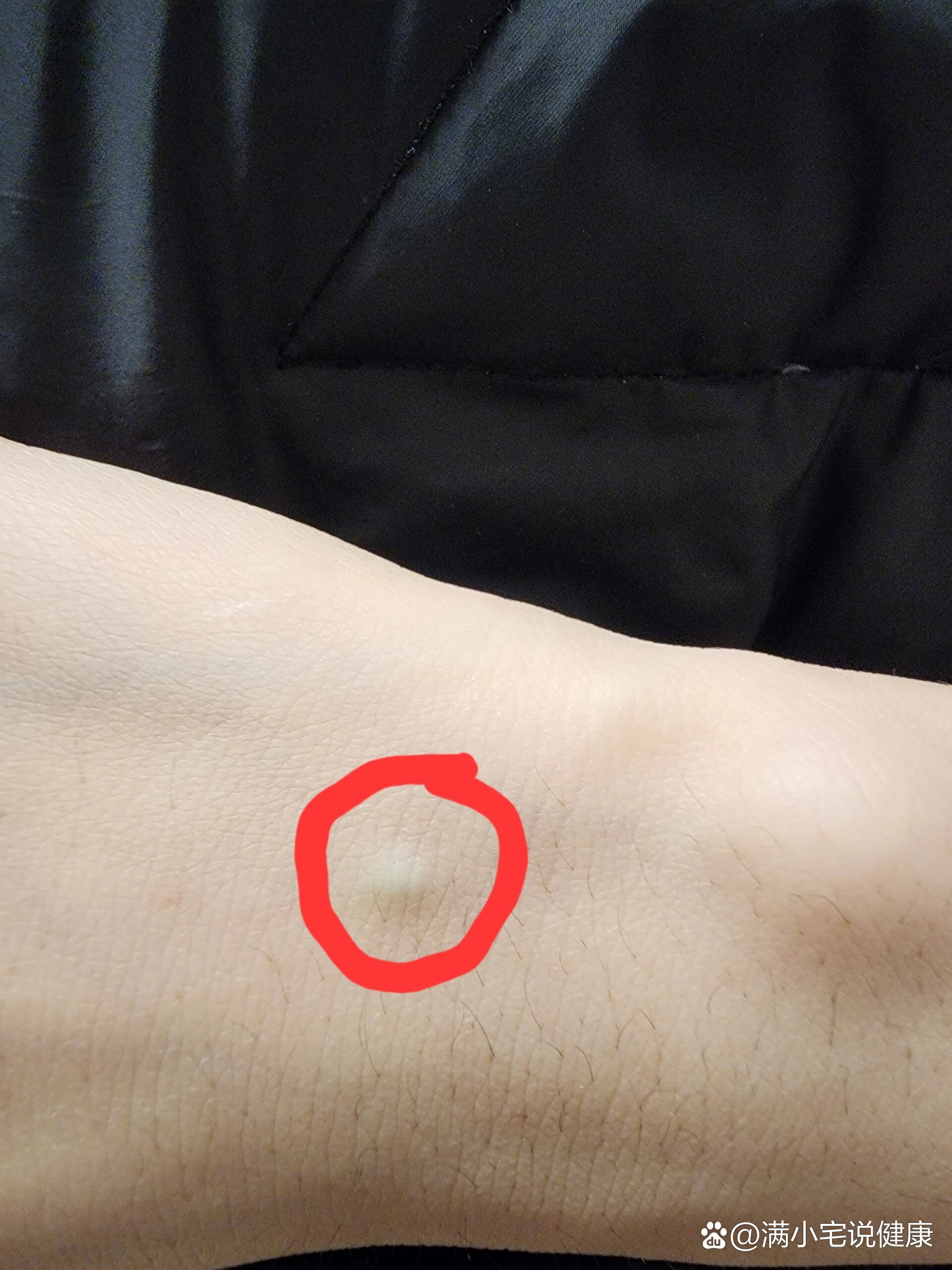 血管里的小疙瘩