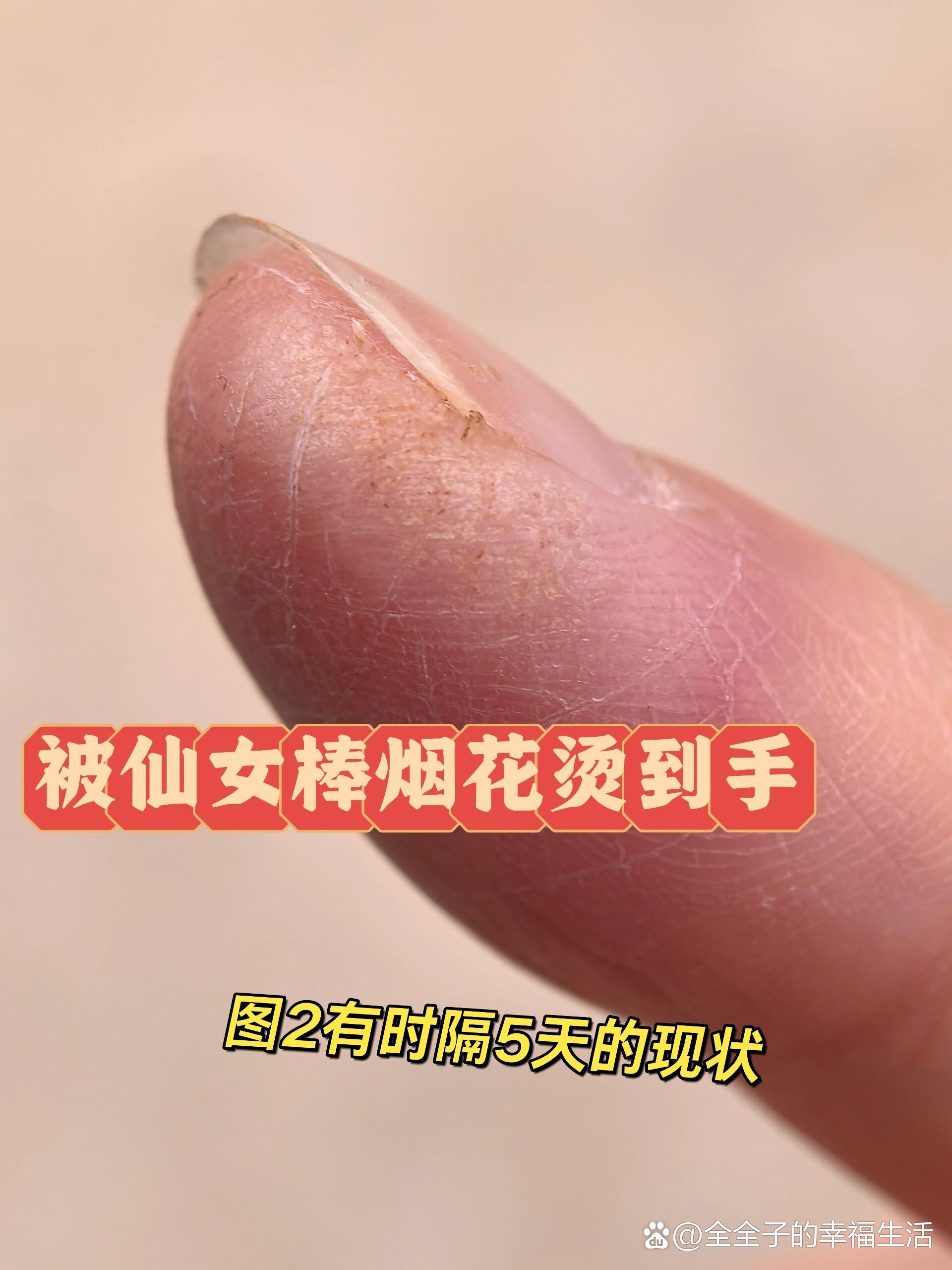 谁懂被烟花烫到大拇指‼️
