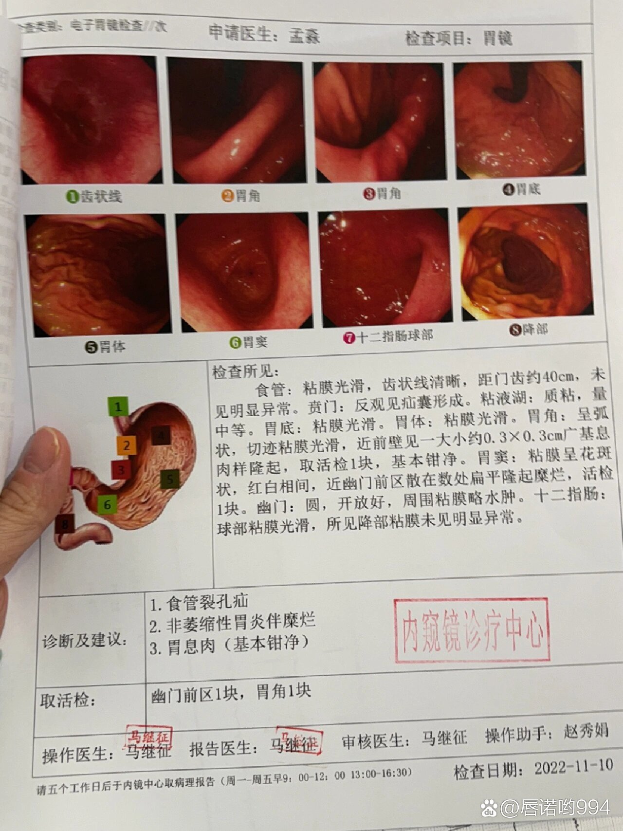 胃镜检查结果正常图片图片