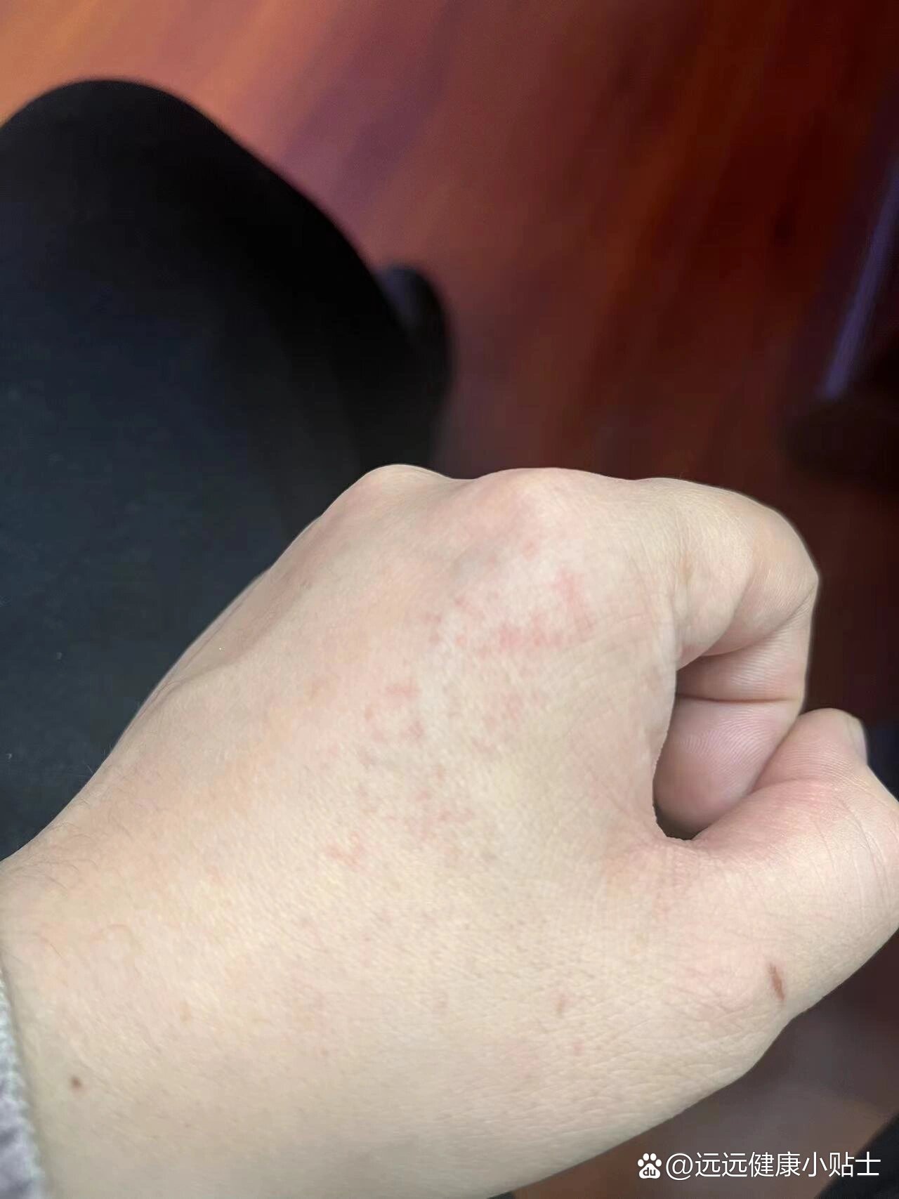 手背上有小红点