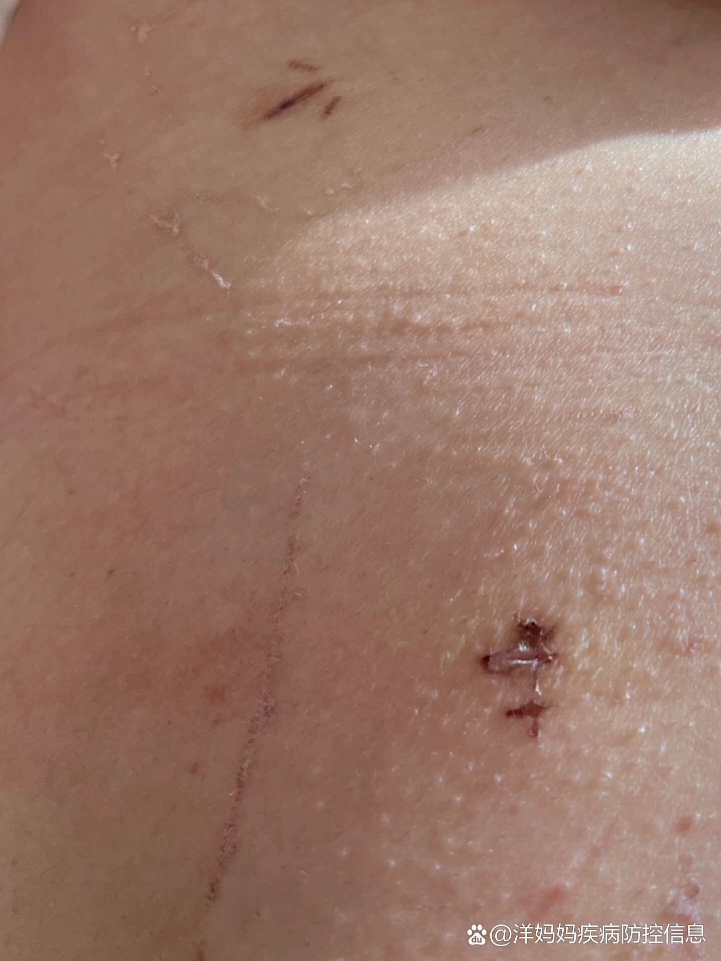 腹腔镜手术后第20天了腹腔镜手术后第20天,伤口似乎恢复有点慢