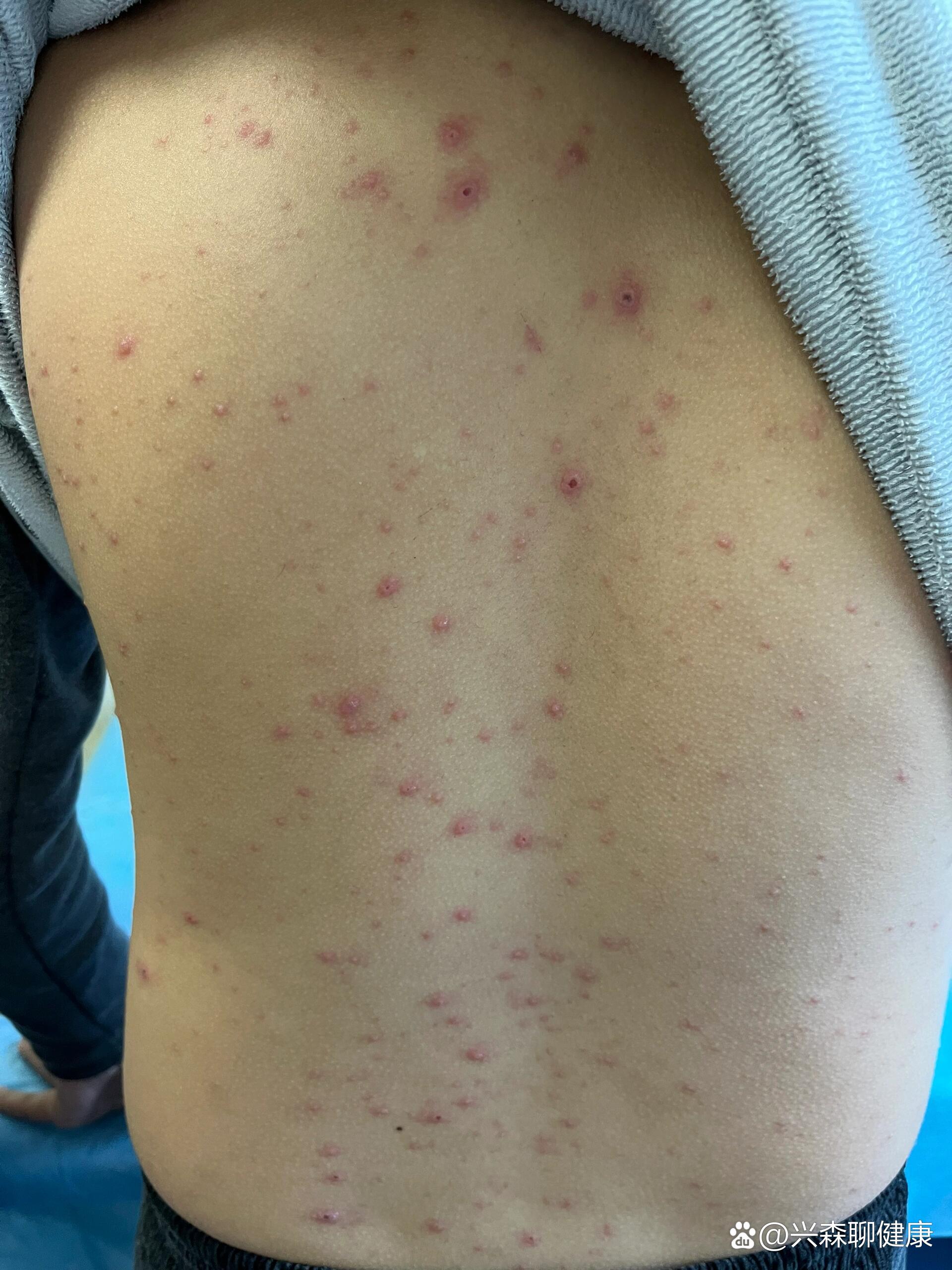 水痘如约而至