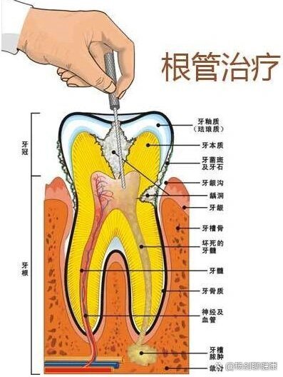 根管是什么样子图片图片