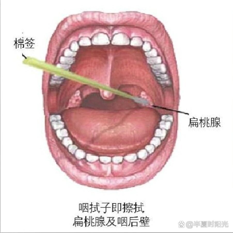 鼻咽拭子采集部位图片图片