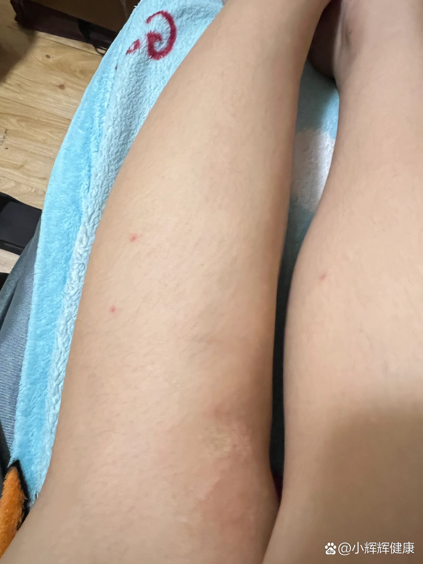 腿上多了几个小红点