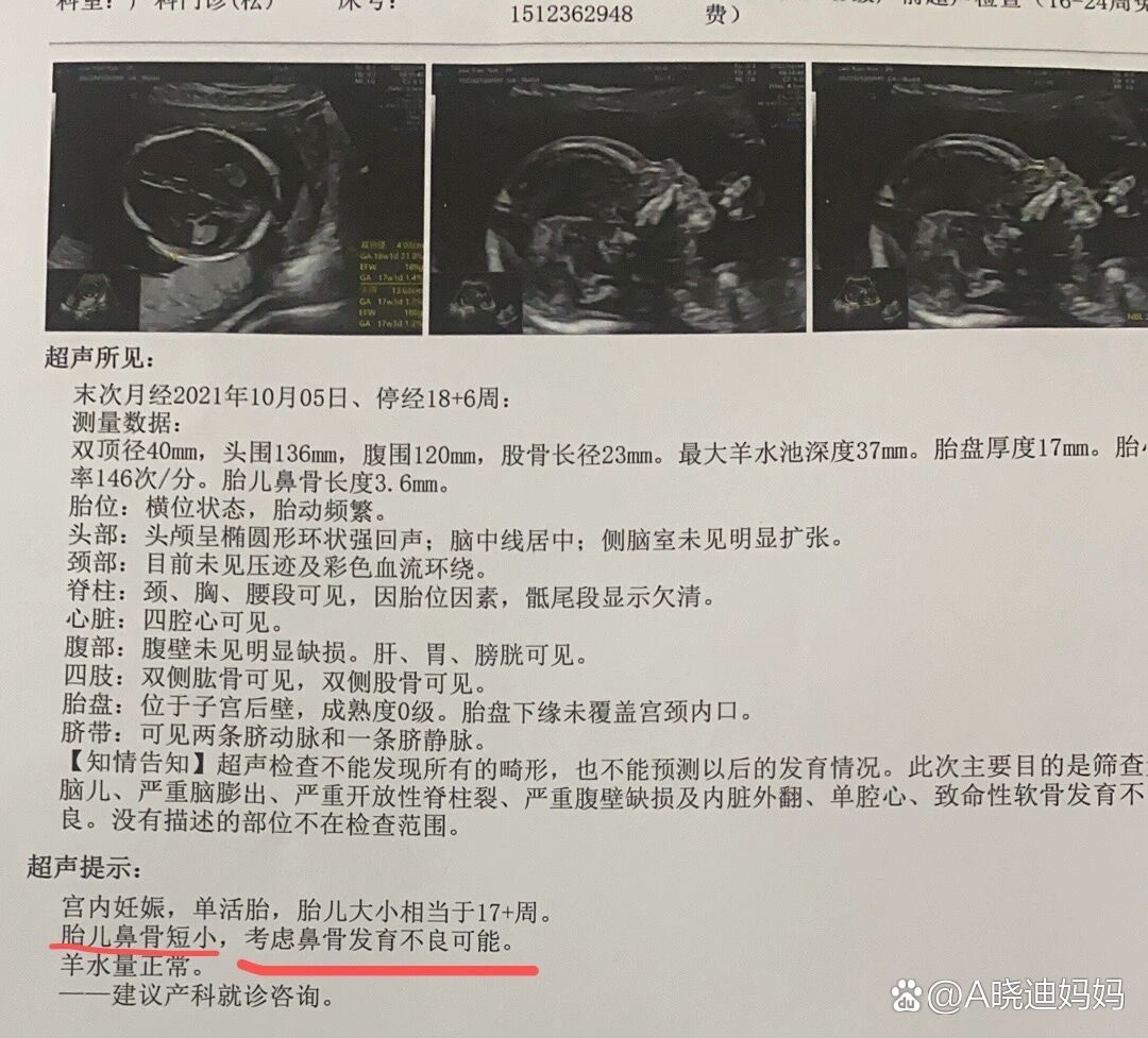 p 18周胎儿鼻骨短小 br 本来打算去做中唐的