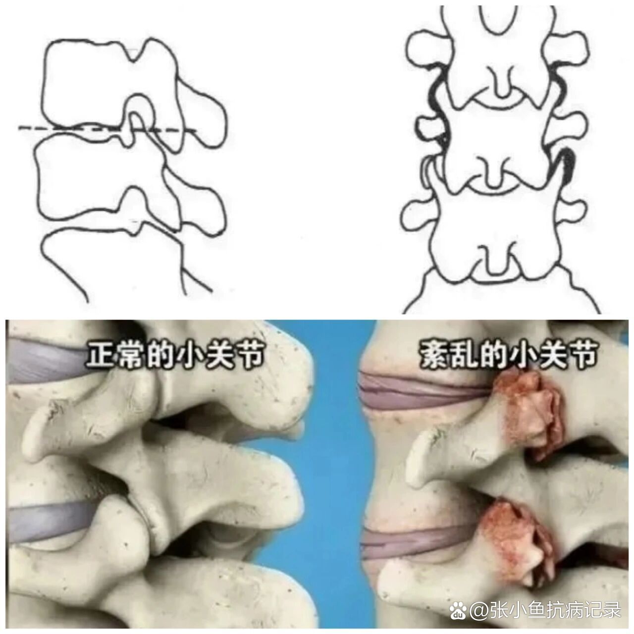 椎小关节骨质增生图片