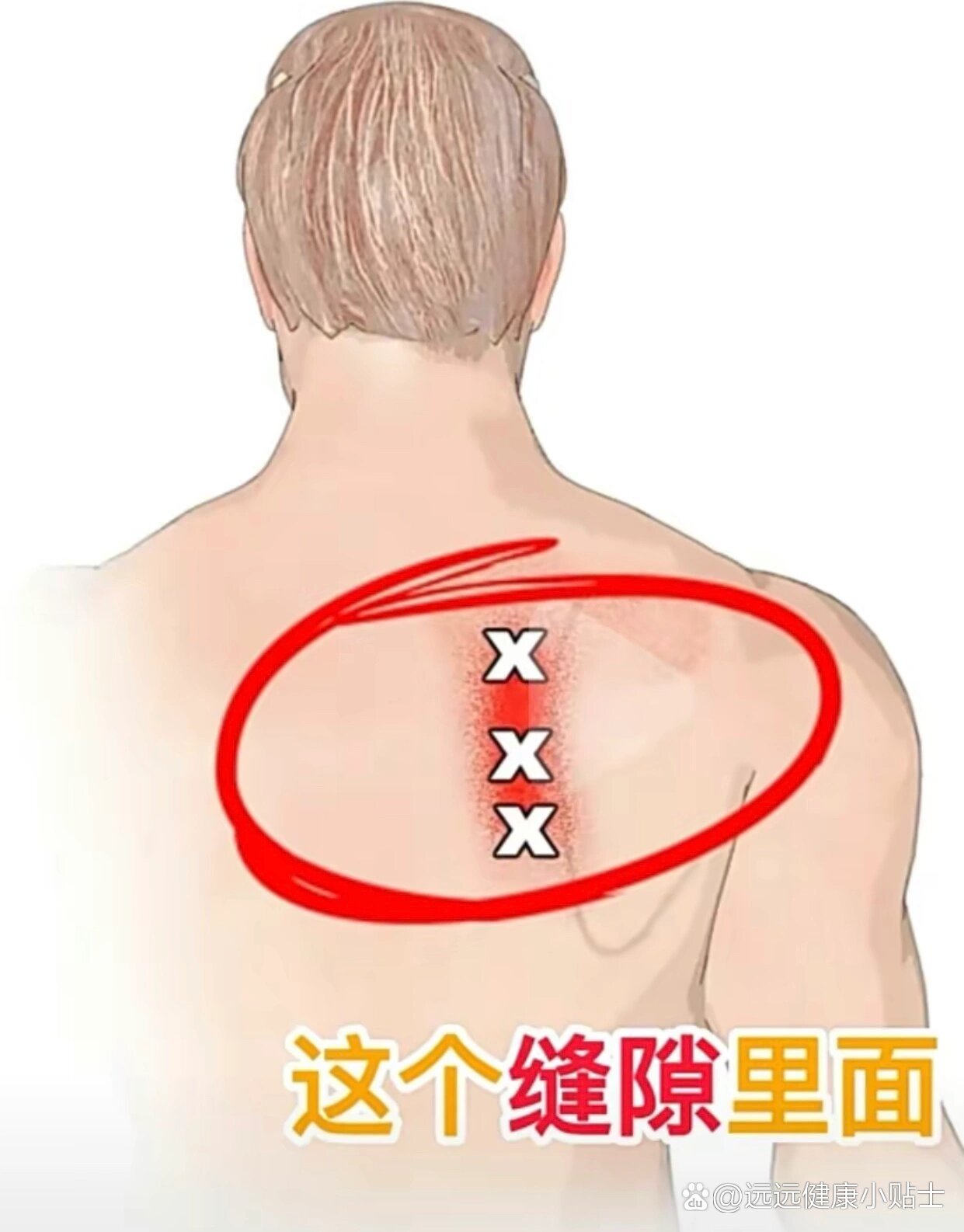 肩胛背神经卡压综合征
